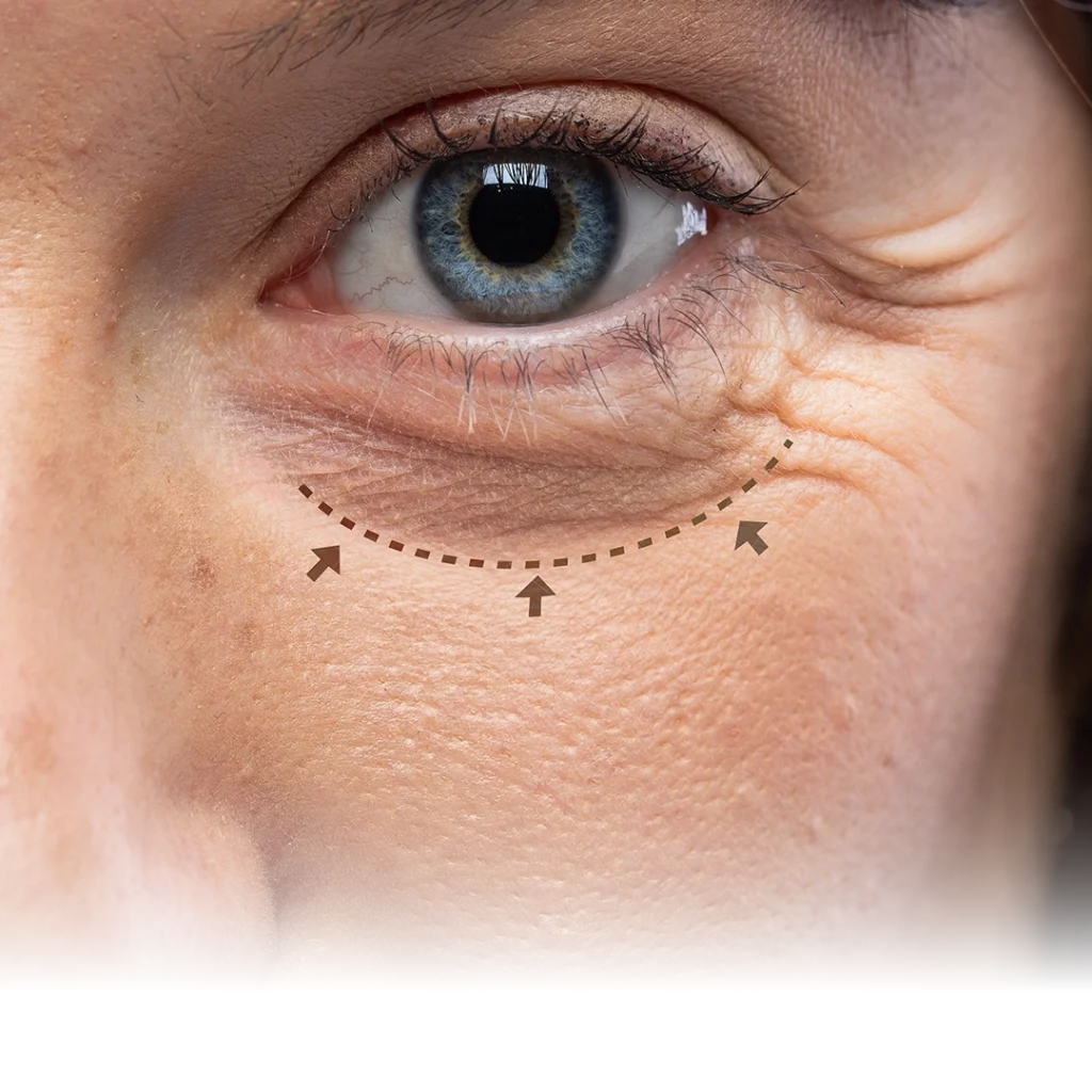 Blefaroplastia